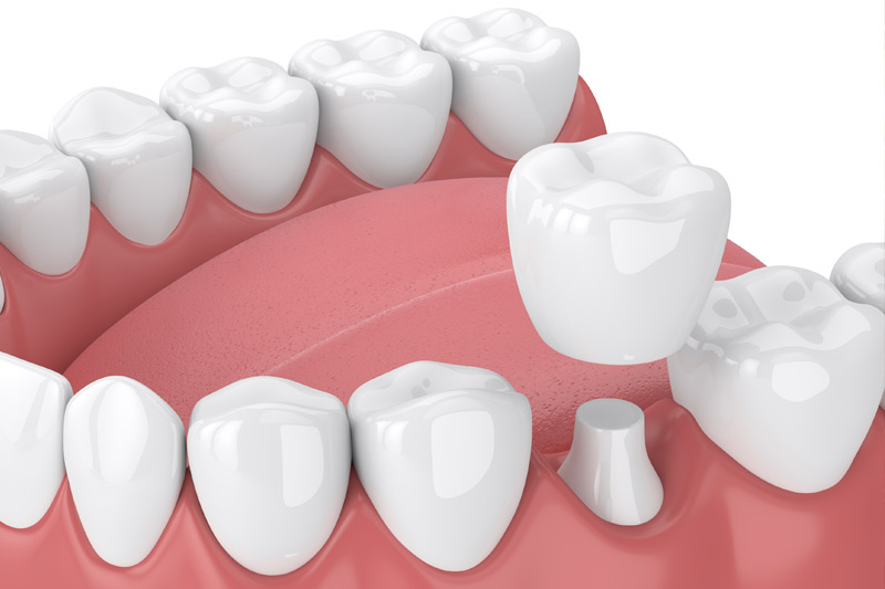 Dental Crowns in Boonsboro