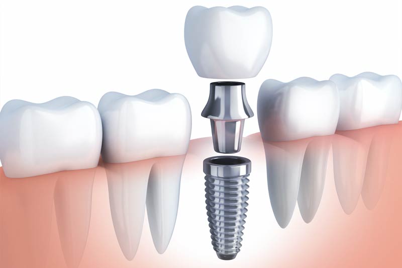 Implants Dentist in Boonsboro